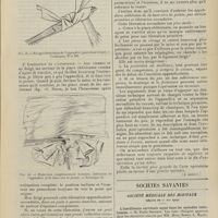 0757 - Page 751 - Comment convient-il d'enlever l'appendice ? Par L. Chevrier... (A suivre) / Sociétés savantes. Société médicale des hôpitaux. (Séance du 21 mai 1909). L'insuffisance surrénale aiguë dans les maladies infectieuses. M. Emile Sergent, la dernières séances par MM. Méry, Netter, L. Martin