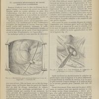 0765 - Page 759 - Comment convient-il d'enlever l'appendice ? Par L. Chevrier...