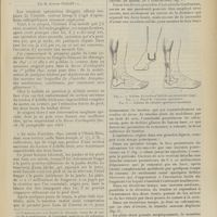0793 - Page 787 - Calcanéotomie verticale postérieure datant de dix-neuf ans, pour une section ancienne du tendon d'Achille, avec écartement considérable des deux bouts du tendon divisé, par M. Antonin Poncet