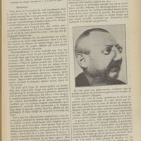 0937 - Page 931 - Clinique chirurgicale. Fibrosarcome ossifiant des fosses nasales ; par M. Jaboulay...