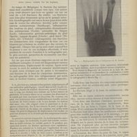 1069 - Page 1063 - Fracture du cinquième métatarsien (considérations sur son mécanisme) ; par M. Salva Mercadé...