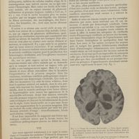 1823 - Page 1817 - Revue générale. Pathogénie de l'hémorragie cérébrale ; par M. Jean Ferrand... VII. / VIII.