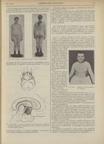 Fig. XII et XIII. Malade de l'observation IX (Babinski) / Fig. XIV et XV. Tumeur occupant la selle t [...]