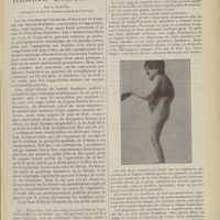 0597 - Page 585 - Abcès par congestion et hernie lombaire ; par C. Claeys...