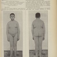 0613 - Page 601 - Clinique chirurgicale de l'Hôtel-Dieu de Lyon. Professeur A. Poncet. Toxi-infection tuberculeuse polymorphe. Double pied plat valgus douloureux. Atrophie testiculaire. - Obésité précoce. - Cyanose des membres. Cicatrices caractéristiques d'une ancienne poly-adénite sous-maxillaire, froide, suppurée, etc. : le tout d'origine tuberculeuse