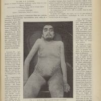 0661 - Page 649 - Syndrome adiposo-génital avec hypertrichose, troubles nerveux et mentaux d'origine surrénale ; par MM. P.-E. Launois... Marcel Pinard... et Alfred Gallais...