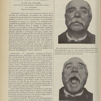 0744 - Page 732 - La mâchoire à clignements. (Jaw-winking-phenomen) ou mouvements involontaires d'élévation palpébrale associés aux mouvements de la mâchoire ; par MM. René Gaultier... et A. Bucquet...