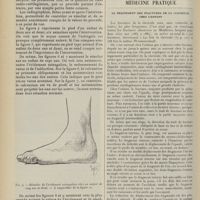 0826 - Page 814 - Traitement pratique du pied bot varus équin congénital irréductible chez l'enfant. Evidement dit sous-cutané des os du tarse, par M. L. Lamy... (A suivre) / Médecine pratique. Le traitement des fractures de la clavicule chez l'enfant. [M. Lance]