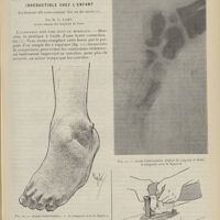 0837 - Page 825 - Traitement pratique du pied bot varus équin congénital. Irréductible chez l'enfant. Evidement dit sous-cutané des os du tarse, par M. L. Lamy...