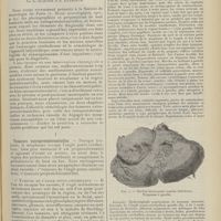 0885 - Page 873 - Sur le diagnostic des tumeurs de la protubérance annulaire ; par L. Alquier et B. Klarfeld