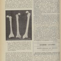 1002 - Page 990 - La préhistoire et les origines de l'humanité dans l'Europe occidentale ; par M. Maurice Faure... (A suivre) / Sociétés savantes. Société médicale des hôpitaux. (Séance du 2 juin 1911). Spirochètes et spirilles de l'intestin. Conditions de leur présence. Leur rôle possible dans certains états de l'intestin. MM. Pierre Teissier et Ch. Richet fils