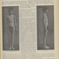 1089 - Page 1077 - Déformations du type acromégalique chez un jeune homme de dix-sept ans ; par M. L. Babonneix