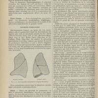 1604 - Page 1592 - Revue générale. Les pleurésies enkystées. Par Henri Paillard... Anatomie pathologique / Etude clinique / Pleurésie interlobaire. Début