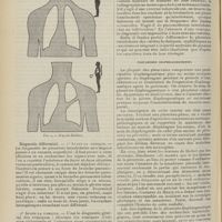 1608 - Page 1596 - Revue générale. Les pleurésies enkystées. Par Henri Paillard... Pleurésie interlobaire. Formes cliniques / Diagnostic différentiel / Pleurésies diaphragmatiques