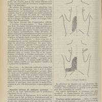 1642 - Page 1630 - Revue générale. Les pleurésies enkystées ; par Henri Paillard... Pleurésies médiastines. Empyèmes du médiastin postérieur / Pleurésies séreuses du médiastin postérieur / Pleurésies sèches médiastines