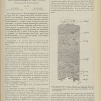 1825 - Page 1813 - Clinique chirurgicale de l'Hôtel-Dieu de Lyon. Professeur A. Poncet. Kyste hémorragique du creux poplité. (Pachysynovite hémorragique), par MM. G. Cotte... et M. Pillon...