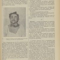 2105 - Page 2093 - Revue générale. Le cancer du canal thoracique. Par M. Albert Piot... III. Symptômes / IV. Diagnostic