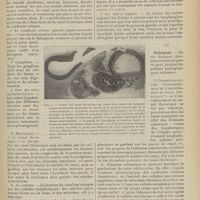 2107 - Page 2095 - Revue générale. Le cancer du canal thoracique. Par M. Albert Piot... V. Anatomie pathologique / VI. Pathogénie