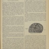 0119 - Page 111 - Malformations multiples de l’axe cérébro-spinal et de son enveloppe osseuse. État réticulaire de la voûte crânienne ; par MM. L. Payan et Ch. Mattei...
