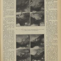 0285 - Page 277 - Revue générale. Diagnostic et traitement des tumeurs de l’hypophyse ; par M. René Toupet... V. Traitement