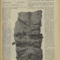 0841 - Page 833 - Un cas de bilharziose intestinale contractée à la Guadeloupe ; par MM. Courtois-Suffit..., Paul Jacquet... et Louis Géry...