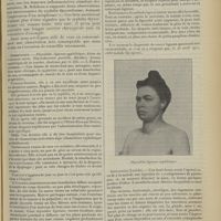 0953 - Page 945 - Syphilis du corps thyroïde ; par MM. Antonin Poncet et René Leriche
