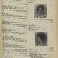 1047 - Page 1039 - De l'exophtalmie unilatérale dans la maladie de Basedow ; par MM. G. Worms... et A. Hamant...