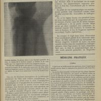 1317 - Page 1309 - Arrachement incomplet de la tubérosité antérieure du tibia ; par M. Félix Masselot... / Médecine pratique. L’ipéca. [M. Brelet]