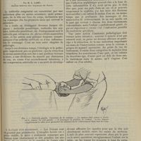 2089 - Page 2081 - Orthopédie pratique. Le traitement du torticolis dit congénital ; par M. L. Lamy...