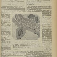 0481 - Page 469 - Hématémèses par artériosclérose gastrique ; par MM. Emile Bitot... et Pierre Mauriac...