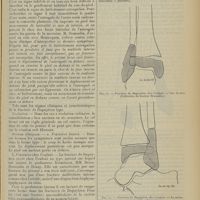 0693 - Page 681 - Revue générale. Fractures du péroné ; par MM. Luquet et Dedet... Fractures de Dupuytren / Complications