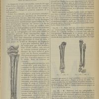 0705 - Page 693 - Radiographies d'ostéomyélites ; par MM. Broca... et Philbert...