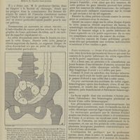1085 - Page 1077 - Clinique médicale. Cancer du côlon pelvien. Par M. Albert Mathieu...