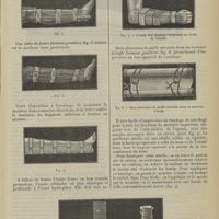 1135 - Page 1127 - Traitement des fractures. Appareils de couchage & de fortune ; par M. Dupuy de Frenelle