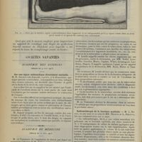 1136 - Page 1128 - Traitement des fractures. Appareils de couchage & de fortune ; par M. Dupuy de Frenelle / Sociétés savantes. Académie des sciences. (Séance du 9 juin 1913). Sur une région endocardique directement excitable. M. R. Argaud / Académie de médecine. (Séance du 17 juin 1913). La déclaration obligatoire de la tuberculose. M. Letulle / Radiumthérapie de la leucémie myéloïde. M. L. Rénon, en son nom et au nom de MM. Decrais et L. Dreyfus