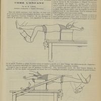 1181 - Page 1173 - Traitement des fractures de la diaphyse du fémur chez l'enfant ; par M. M. Lance...