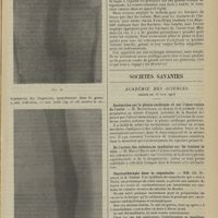 1187 - Page 1179 - Traitement des fractures de la diaphyse du fémur chez l'enfant ; par M. M. Lance... / Sociétés savantes. Académie des sciences. (Séance du 16 juin 1913). Recherche sur le plexus cardiaque et sur l'innervation de l'aorte. M. Manouélian / De l'action des substances oxydantes sur les toxines in vivo. M. Marcel Belin / Vaccinothérapie dans la coqueluche. MM. Ch. Nicolle et A. Conor