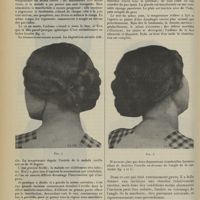 1402 - Page 1394 - Clinique chirurgicale. L'évacuation des suppurations parotidiennes diffuses et graves. Par M. H. Morestin...