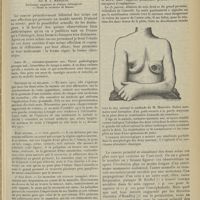 1459 - Page 1451 - Le cancer des mamelles bilatéral d'emblée. Par M. E. Marquis...