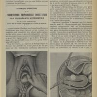 1565 - Page 1557 - Le diabète hypophysaire. Par MM. Paul Sainton et Louis Rol / Technique opératoire de la fibromyectomie transvaginale conservatrice par colpotomie antérieure. Par M. Louis Dartigues...