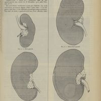 1973 - Page 1965 - Atrophie rénale unilatérale. Par MM. L. Babonneix et R. Turquety