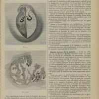 2123 - Page 2115 - Revue générale. Des kystes du sein. Par M. P. Alglave... Kystes sur tumeurs solides bénignes / Maladie kystique de la mamelle