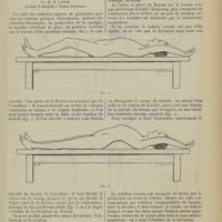 2133 - Page 2125 - L'appareil plâtré en deux parties dans le redressement des positions vicieuses de la hanche. Par M. M. Lance...