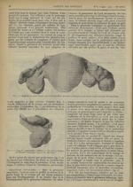 Fig. 2. Rupture (au point marqué par la flèche) d'une grossesse isthmique juxta-utérine ayant nécess [...]