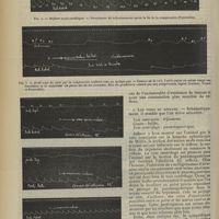 0834 - Page 838 - Revue générale. Le réflexe oculo-cardiaque ; par MM. Maurice Vernet... et Petzetakis... II. Le réflexe / III. Manière de rechercher le réflexe