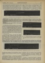 Fig. 11. L'abolition du réflexe oculo-cardiaque dans la maladie de Parkinson (Lesieur, Vernet et Pet [...]