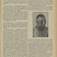 1253 - Page 1257 - Revue générale. L’oedème malin charbonneux ; par MM. Marcel Carrieu..., et Spyridion N. Oeconomos... V. Symptomatologie