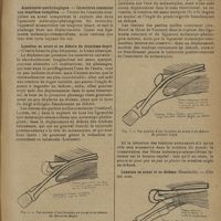 0151 - Page 147 - Revue générale. Les luxations métacarpo-phalangiennes du pouce en avant ; par Raoul Garling Palmer... Classification / Anatomie-pathologique. Caractères communs aux luxations complètes / Luxation en avant et en dehors du deuxième degré / Luxation en avant et en dehors du premier degré / Luxation en avant et en dedans (Meschédé)