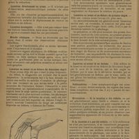 0152 - Page 148 - Revue générale. Les luxations métacarpo-phalangiennes du pouce en avant ; par Raoul Garling Palmer... Luxation en avant et en dedans (Meschédé) / Luxation directement en avant / Luxation incomplète / Etude clinique / Luxation en avant et en dehors du deuxième degré / Luxation en avant et en dehors du premier degré / Luxation en avant et en dedans / Subluxations / Evolution