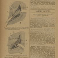 0396 - Page 394 - Les ligatures difficiles ; par H. Billet... Ligature de l'artère fémorale dans le canal de Hunter / Sociétés savantes. Société médicale des hôpitaux. (Séance du 22 février 1929). La cachexie de croissance. MM. May et Layani / La radiothérapie des tumeurs de l'hypophyse. M. Béclère / Glycémie et épreuve d'hyperglycémie chez les hépatiques. MM. Labbé et Fl. Nepveux / Sanocrysine par voie intrapleurale. MM. Léon Kindberg et E. Royer de Véricourt